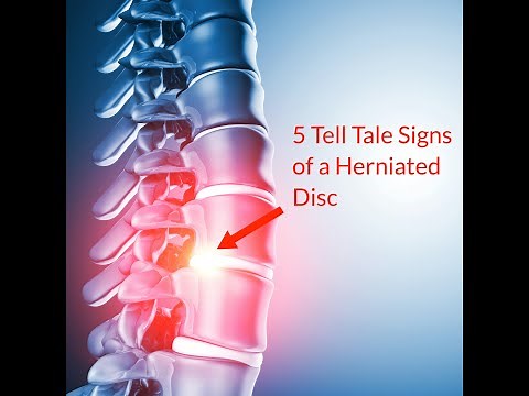 Self-Diagnose: 5 Tell Tale Signs of a Slipped Disc