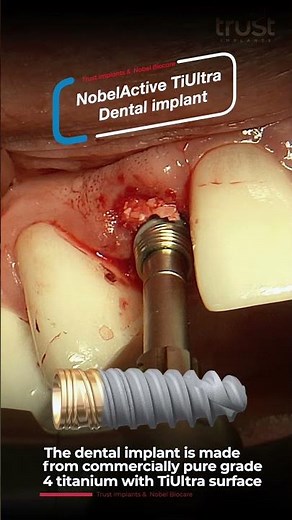 The Future of Smiles: A NobelActive TiUltra Implant Journey at @Trustimplants