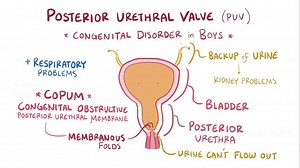 Video: Posterior urethral valves - Video Explanation! | Osmosis | Osmosis