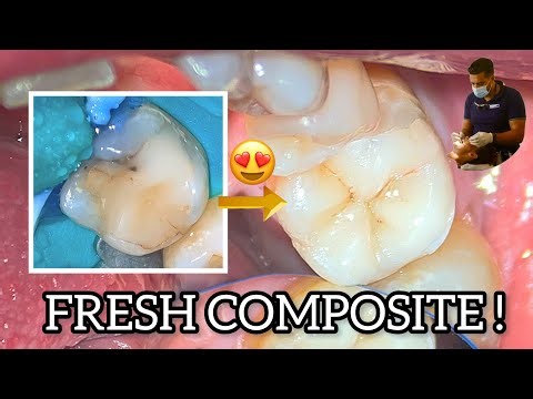 Replacing Old Composite on Lower Second Molar | Cusp-by-Cusp Restoration 4K #dentist #fyp #foryou