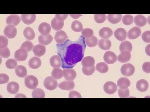 Reactive Lymphocytes