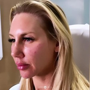 Juvederm Vollure and Voluma to the Cheeks, Chin, Temples, Lips, and Nasolabial Folds | Female Facial Sculpting