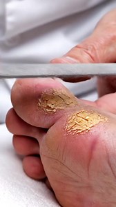 Extreme Foot ASMR | Satisfying Heel Scrape #footcare #heeleexfoliation #pedicure #oddlysatisfying #dryskinremoval Enjoy clean, relaxing foot-care ASMR with gentle heel exfoliation and natural callus removal. Disclaimer: AI-generated educational & relaxation content. | Loro Choco