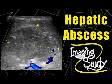 Hepatic Abscess || Ultrasound || Case 73