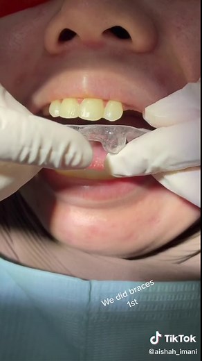 Fixing Hypodontia with Braces: Dr. Azura's Case