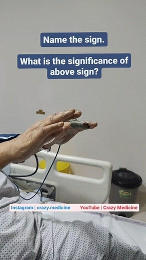 crazy.medicine on Instagram: "Answer: Asterixis (Flapping tremors). Asterixis is a clinical sign that describes the inability to maintain sustained posture with subsequent brief, shock-like, involuntary movements. This motor disorder is myoclonus characterized by muscular inhibition (whereas muscle contractions produce positive myoclonus). It is most commonly associated with metabolic encephalopathies, especially hepatic. The presumption in hepatic encephalopathy was that damage to brain cells d