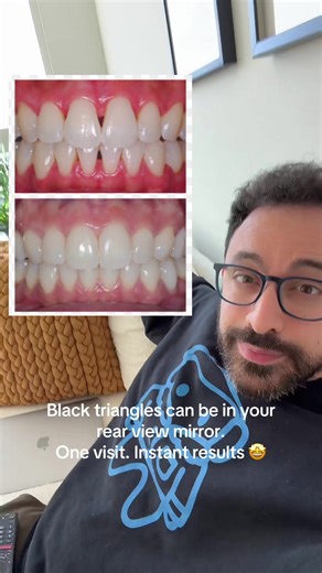 Bioclear Black Triangle Closure: Instant Results