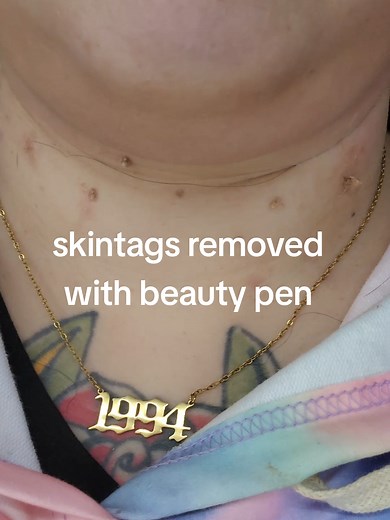 Effective Skin Tag Removal with Beauty Pen