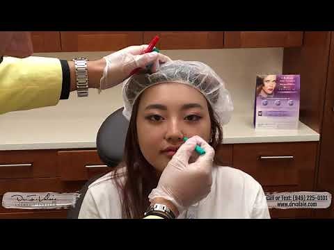 Gummy Smile Botox + Nose and Lips Improvement by injection only! - Dr. Valaie, MD