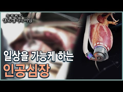 [생로병사 20주년_인체로드] 숨가쁘지 않은 일상을 선물하는 인공심장의 최신기술 (KBS 20211208 방송)