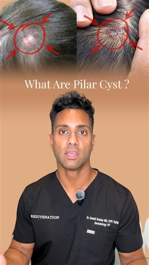 Dr. Grenvil Gracias, MD | 📍Calgary | Botox | Filler | Cosmetics | What are Pilar cysts? Pilar cysts are hair follicle–based cysts that appear most often on the scalp. They can form from infection, trauma,... | Instagram