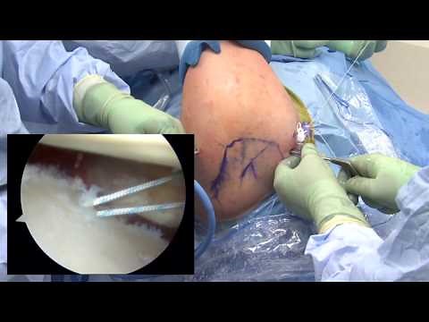 Arthroscopic Bankart Repair • Video • MEDtube.net