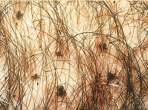 What does crabs look like on pubic hair? [2025] | QAQooking.wiki