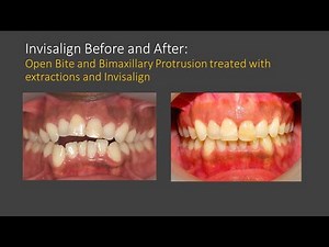 Invisalign Before and After: Open Bite Correction with Invisalign Clear Aligners