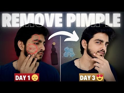 Face Pimples Removal Naturally | Acne Treatment at Home | Pimple Treatment