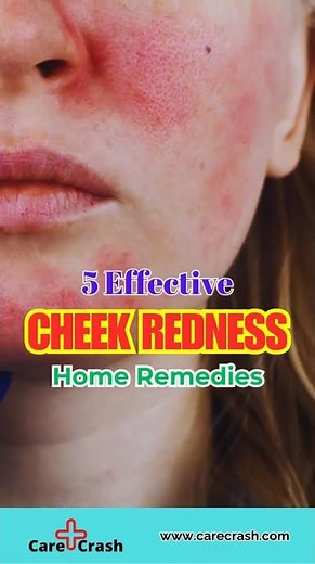 5 Soothing Cheek Redness Home Remedies | #carecrash