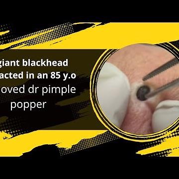 giant blackhead extracted in an 85 y.o remove dr pimple popper