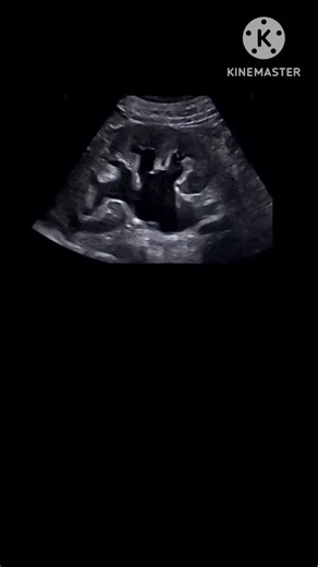 Hydronephrosis grade??? #ultrasound