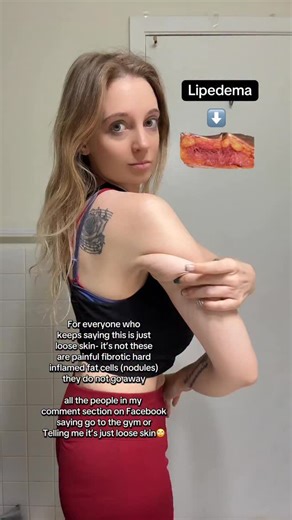 12K views · 515 reactions | For anyone saying “just lift weights” or “it’s loose skin” — this is lipedema. These are fibrotic fat nodules that can be painful and inflamed. They don’t simply shrink with dieting or workouts. Understanding this changes everything. Education over judgment. Always. Comment “mini” if you want a free inflammation guide 懶 #lipedemaeducation #lipedemaarms #inflammation #chronicpain #bodytruth | Michelle - Lipedema Care | Facebook
