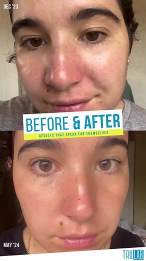 TruLab transformation! ✨ Witness the journey from December 2023's troubled skin to May 2024's radiant complexion, all thanks to the consistent use of our TruLab skincare routines and products. 🌟 Here's the lineup of products that paved the way for this remarkable change, along with the most important thing each product does: 🌞 Daytime Routine: 1. Selfie Skin AHA Cleanser - Gently exfoliates to reveal smoother, more radiant skin. 2. Hey Gorgeous AHA Toner - Refines texture and unleashes your sk