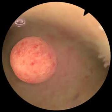 Myomectomy - New Features for Virtual Reality Surgical Simulation