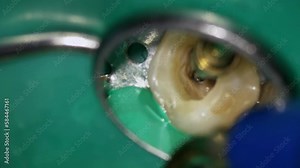 Rotten tooth in macro footage and dentist treating it with drill mirror and corkscrew. Closeup view of decay chewing molar with deep hole destroyed by caries and doctor restoring it with prof tools