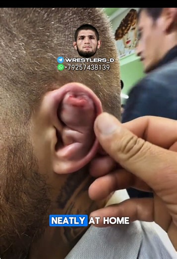 How to Manage Cauliflower Ear: A Helpful Tutorial