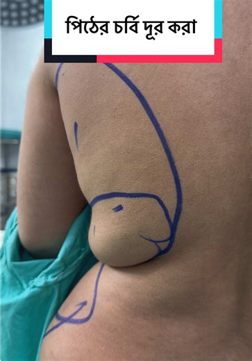 পিঠের চর্বি দূর করা। Back fat reduction #liposuction #lipo #bodycontouring #bodyshaping #fatreduction @Dr Iqbal Ahmed