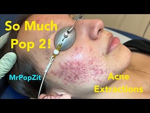 So much POP 2! See her 2 week follow up and how much better she is doing from just one session.