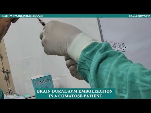 Brain Dural AVM Embolization: Saving a Comatose Patient | Dr. Sandeep Sharma | IRFACILITIES
