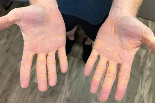 18K views · 141 reactions | Dr. Konstantinos Marmagkiolis explains how a Tampa man developed a rare condition known as Xanthelasma after eating 6 to 9 pounds of cheese, sticks of butter and hamburgers every day for 8 months. It resulted in deposits of cholesterol under his skin. Marmagkiolis is an Interventional Cardiologist with Tampa Heart, Tampa General Hospital, and USF Health. He authored a study on this patient published in JAMA Cardiology. | FOX 13's Haley Hinds | Facebook