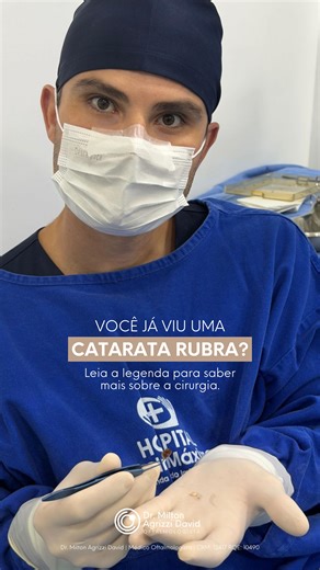 Dr. Milton Agrizzi David | Cirurgião Oftalmologista | Hoje realizamos uma cirurgia de catarata rubra, um tipo mais avançado de catarata. Nesse caso, foi necessária a extração extracapsular, uma... | Instagram