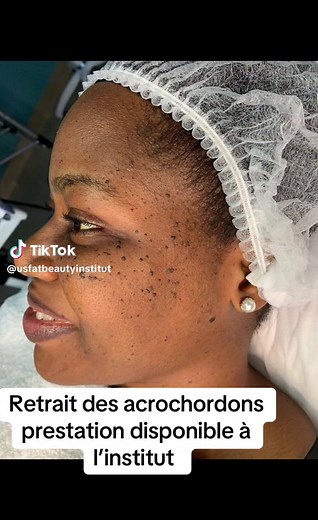Tout savoir sur les acrochordons : causes et solutions