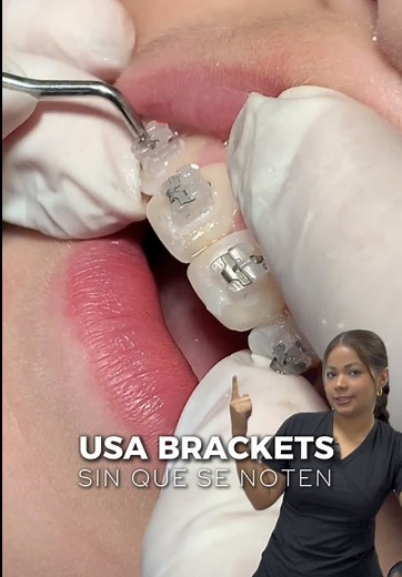 ✨¿BRACKETS CASI INVISIBLES? ✨ Los brackets autoligados cerámicos combinan las ventajas del sistema autoligado, como menor fricción, mayor comodidad, una higiene bucal más sencilla y menos citas con el ortodoncista, con la estética discreta de los brackets de cerámica. #Ortodoncia #bracketsautoligado #bracketsceramicos #ortodonciainvisible #controldeortodoncia