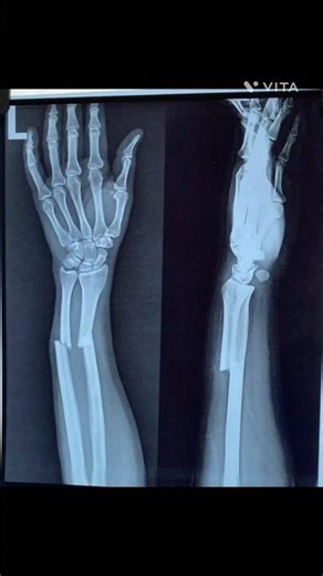 Both bone forearm(Radius-Ulna) fracture recovery #fracture #fracturerecovery #nagpur