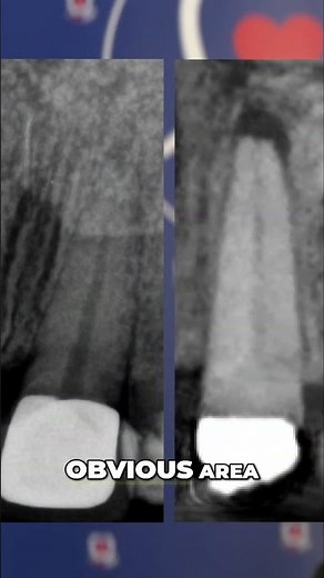 Cone Beam CT Scan Solving Dental Mysteries