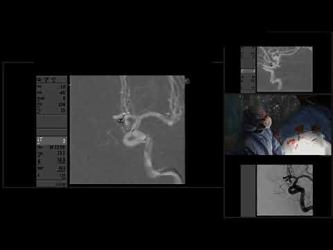 Endovascular coil embolization of 2 cerebral aneurysms