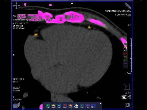 How to perform a cardiac CT scan for TAVI