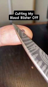 Blood Blister healing naturally