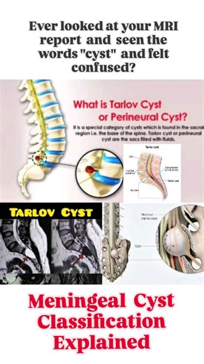 Adeel Ur Rehman on Instagram: "Spinal cyst"is a general term, but the type and location matter a LOT! Here’s a 20-second guide to the 3 classifications of meningeal cysts. Swipe through to see the key differences on MRI: 1. Type 1 - Extradural 2. Type 2 - Tarlov Cyst 3. Type 3 - Arachnoid Knowledge is power when it comes to your health! 💪 Follow for more clear breakdowns of complex medical topics. #MedicalKnowledge #HealthTips #DoctorExplains #SpinalCyst #TarlovCystAwareness #ArachnoidCyst #Med
