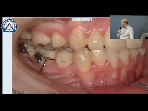 Monday Tip: Uprighting Ectopic Molars