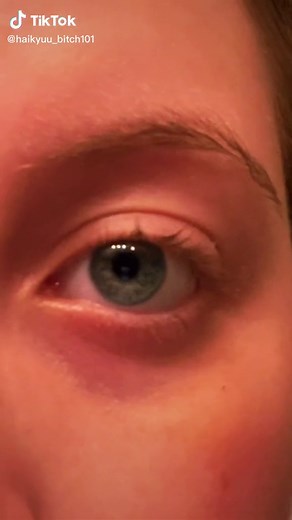 Red Vein in Eye: What Causes It and How to Treat it