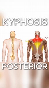 Kyphosis is the forward rounding of the upper back, often caused by...