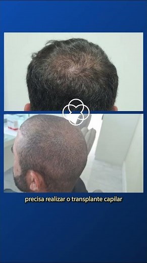 QUANTO CUSTA UM TRANSPLANTE CAPILAR? 😱 E A QUALIDADE? #TransplanteCapilar #drpaulolu APARÊNCIA REAL
