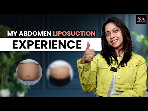 My Abdomen Liposuction Experience | Liposuction Surgery in Delhi | Best Liposuction Surgery in Delhi