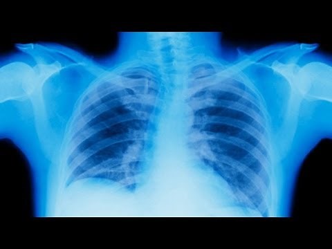 Stages of Lung Cancer