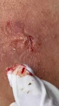 Big Cystic Acne Blackheads Extraction Blackheads & Milia, Whiteheads Removal Pimple Popping #shorts