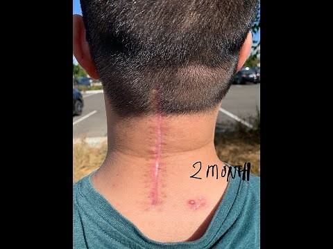 MY SCAR AFTER 2 MONTHS OF POSTERIOR CERVICAL DECOMPRESSION AND FUSION C2-C6 NECK SURGERY