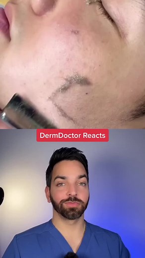 Satisfying though @bada061 #dermdoctor #dermaplaning #dermatologist