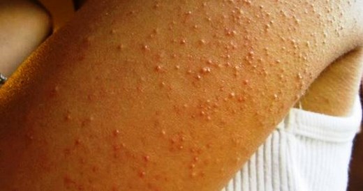 10 Traitements Efficaces pour les Boutons sur les Bras (Petits ou Rouges)